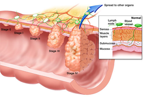colon-tumors.jpg